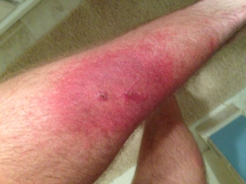 An allergic reaction to poison ivy.